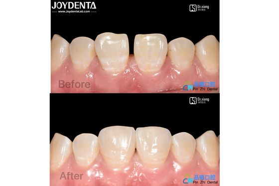 Carillas de porcelana de ajuste seguro Tratamiento dental Carillas de resina compuesta resistentes a las manchas