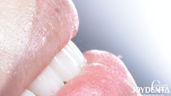 Las carillas de porcelana de alta durabilidad y buena biocompatibilidad