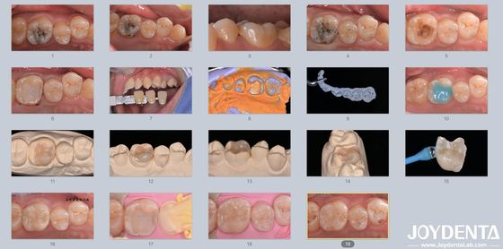 Adultos Niños Incremento dental de cerámica de porcelana Restaurador para dientes dañados