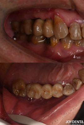 Implante dental de diseño de superficie áspera para material de titanio a nivel de hueso subcrestal