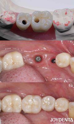 Implantes dentales de titanio de 4 cilindros con conexión hexagonal de 10 a 16 mm de longitud