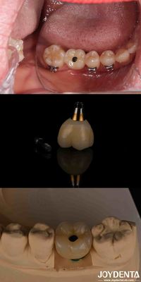4-6 Implante dentario endosseo cónico Subcrestal Nivel óseo y conexión hexagonal interna