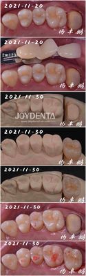 Proceso dental de inserción de porcelana sin costura Forma personalizable para la reparación de dientes