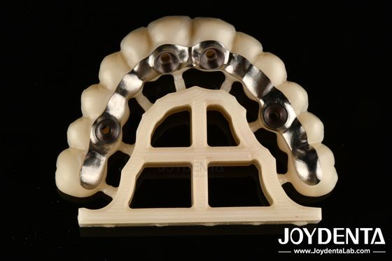 Finitura de plata Abutments y barras personalizadas de ajuste preciso Retener tornillo o cementos