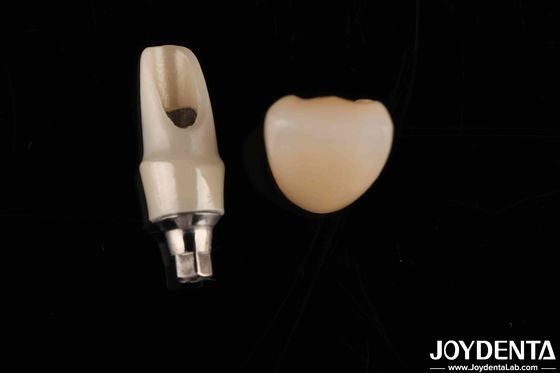 Abutments y barras de zirconia personalizadas Restauraciones dentales para la anatomía individual del paciente