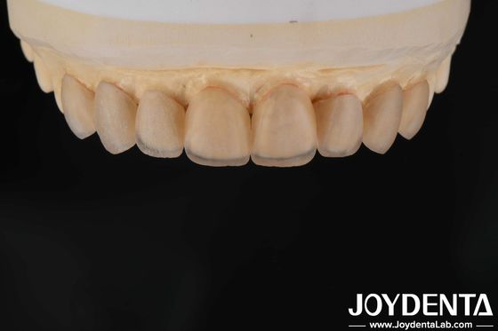 Apariencia natural Carillas cerámicas de vidrio, carillas de clínica dental Enlace fuerte