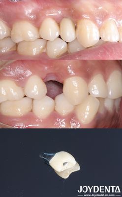 Implante dental de forma cilíndrica Titán Implante dental superficie áspera