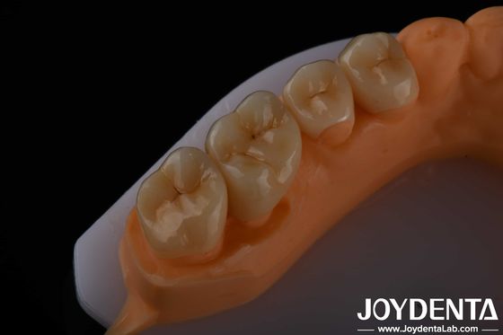 Alta estética Zirconia de contorno completo para coronas puentes implantes restauraciones dentales