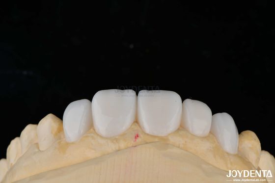 Materiales de porcelana de personalización carillas de dientes Emax para una unión de alta estética