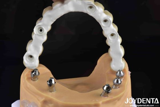 Solución dental de alta resistencia de puente de zirconia híbrido de base de Ti resistente a fracturas