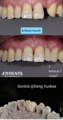 Dientes traseros de puente de Maryland unidos con resina para cepillar con hilo dental regular