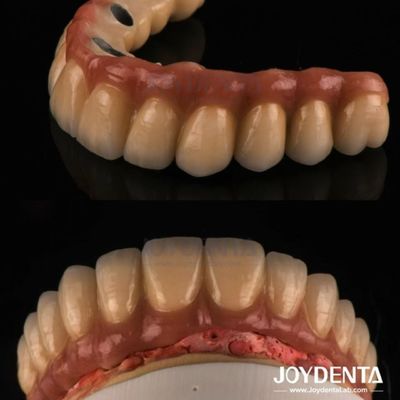 Fundir y fresar PFM Corona de dientes, restauraciones dentales Corona de metal fundido de porcelana
