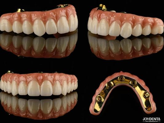 Puentes de implantes híbridos de Ti Bar Zirconia de alta translucidez para prótesis dental