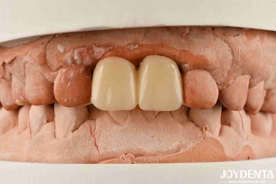 Polymethyl methacrylate de PMMA multicapa para restauraciones dentales