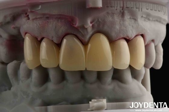 CAD CAM Procesamiento Dental PMMA Material Diseño multicapa para transiciones naturales de sombra