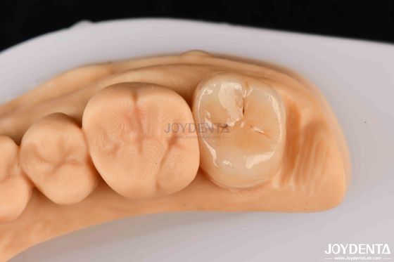 Alta resistencia Emax Inlay Onlay A2 Color Duradera para la restauración de dientes dañados