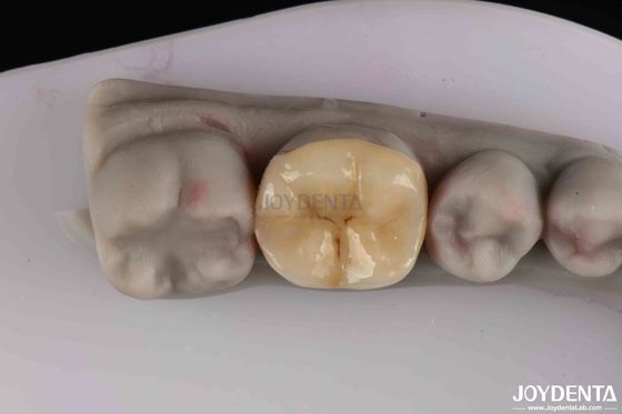 Inlay de zirconia personalizable Onlay Preparación mínima para la restauración de dientes dañados