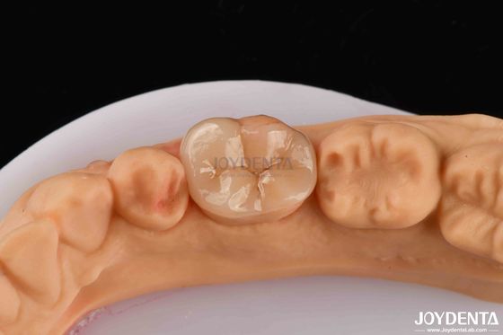 Alta durabilidad Dental Inlay Onlay Compuesto Apariencia natural