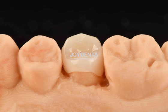 Inlay compuesto blanco personalizable Onlay de aspecto natural Restauración dental mínimamente invasiva