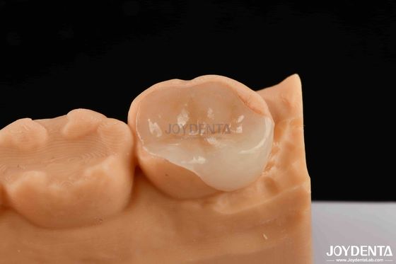 Porcelana polimerizada Compuesta Incrustación y Onlay Restauración Estética y Duradera