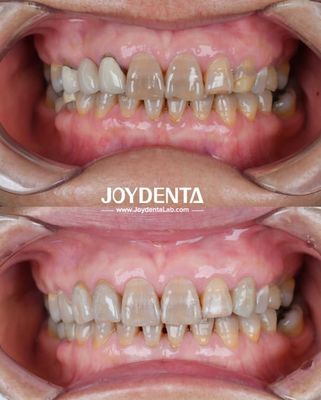 Circonia dental ligera para una experiencia óptima del paciente Transiciones de color naturales y biocompatibilidad garantizada