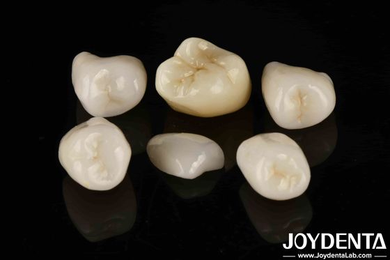 Fácil cementación Emax Inlay Onlay Fuerza media Estética de aspecto natural