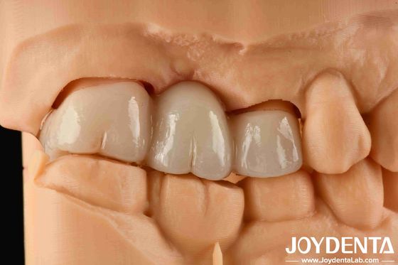 Experiencia de color realista de zirconia completa con alta resistencia a la tinción y resistencia a la flexión de 1000 MPa