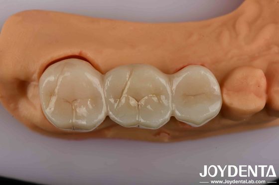 Circonia dental de alta resistencia su solución definitiva para una estética de aspecto natural