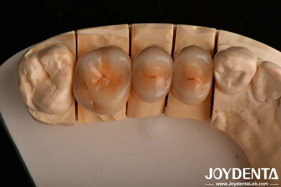 Alta resistencia a las astillas y estética de aspecto natural con tecnología de zirconia completa de múltiples capas