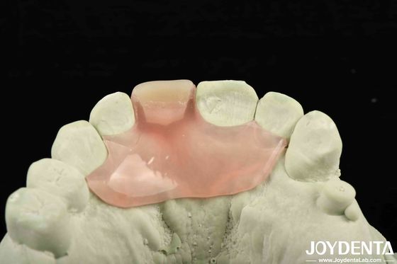 Personalización de la prótesis dental Flexible Finish utilizando la tecnología de disposición de dientes con buena elasticidad