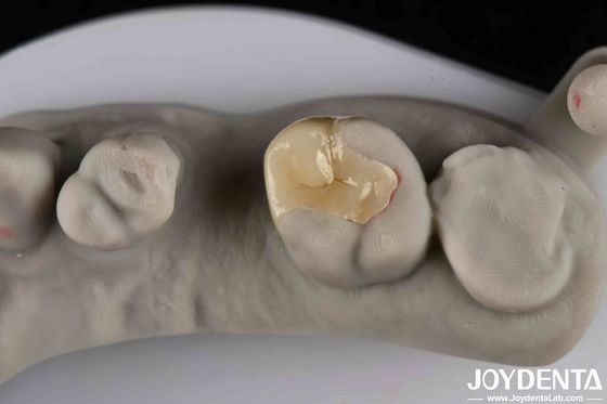 Resistencia a las fracturas Emax Inlay Onlay Estética y durabilidad de aspecto natural