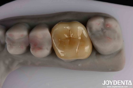 Mediana translucidez Emax Inlay Onlay fácil limpieza y biocompatibilidad no tóxica en los materiales