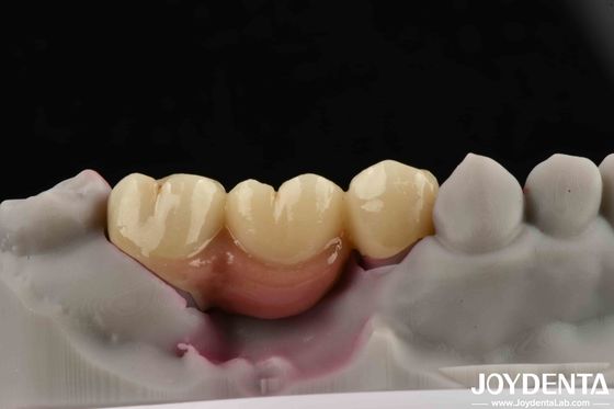 Puente y corona de apoyo de implantes dentales personalizables para implantes dentales
