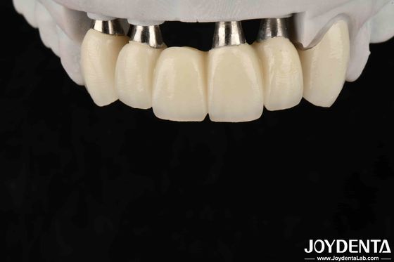 Corona y puente de implantes personalizables para una biocompatibilidad oral segura