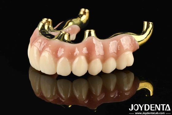 Restablecimiento de la función de masticación Puente híbrido de Ti-Bar Zirconia con alta biocompatibilidad y ajuste preciso