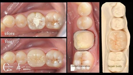 Biocompatibilidad y alta compatibilidad con la restauración de dientes naturales