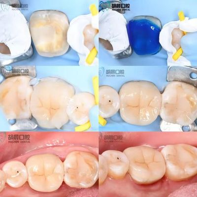 Experimenta la precisión de la incrustación dental asequible y blanca para un ajuste perfecto