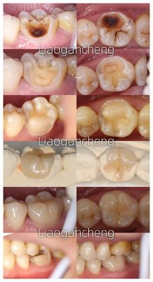 Incremento dental de porcelana restaurador para adultos y niños Rendimiento excepcional