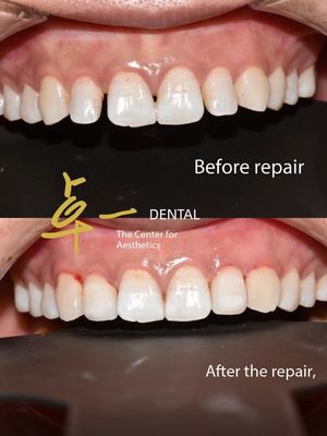Saludos a una sonrisa impecable con carillas cosméticas sin decoloración sin preparación
