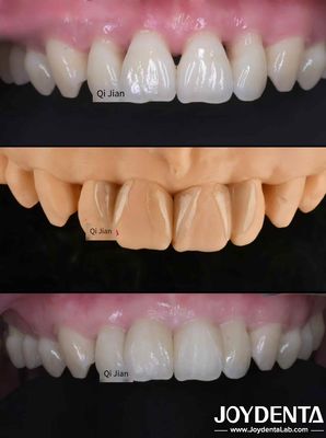 Las carillas de la langosta La solución perfecta para las carillas dentales translúcidas naturales
