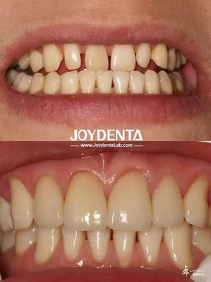 Carillas dentales duraderas sin decoloración perfectas para necesidades de abastecimiento B2B y más