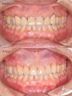 Circonia dental de alta resistencia a las fracturas para tejidos orales seguros y compatibilidad CAD / CAM