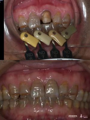 Coronas de zirconia translúcidas Tecnología de gradiente multicapa para una translucidez óptima y biocompatibilidad a largo plazo