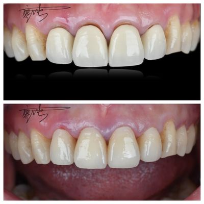 Confortables puentes dentales de zirconia de peso ligero Transiciones de color natural para una experiencia óptima del paciente