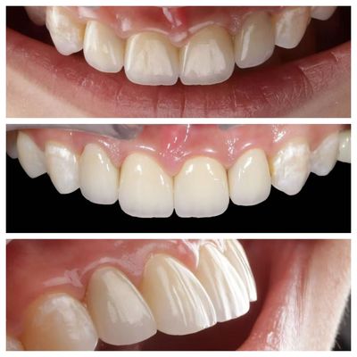 Indicación del diente anterior carillas dentales con 0,5 mm de espesor y permeabilidad perfecta