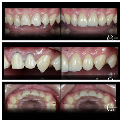 Carillas dentales naturales para una sonrisa natural y hermosa
