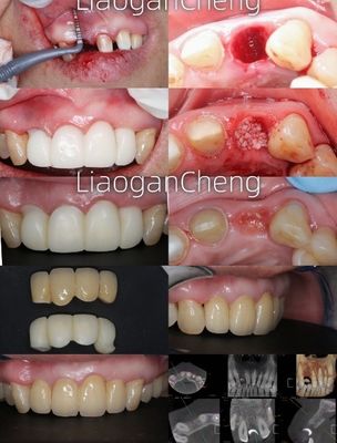 Tecnología de gradiente multicapa Zirconia dental segura y estéticamente agradable a largo plazo
