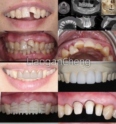 Biocompatibilidad Coronas dentales seguras de zirconia para restauraciones a largo plazo y con implantes