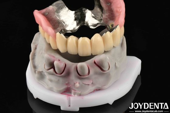 Material metálico dental avanzado para apoyar las necesidades de masticación