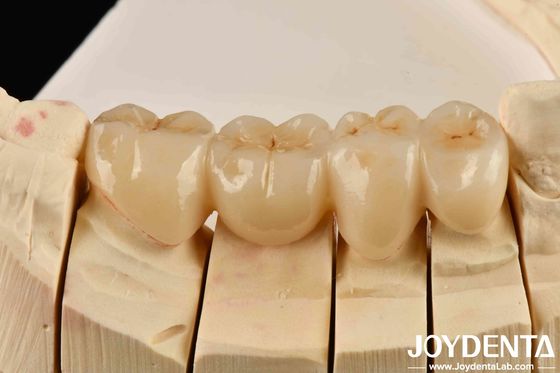 Desata la estética de la alta estética completa de zirconio con blanco y resistencia a los golpes térmicos alta